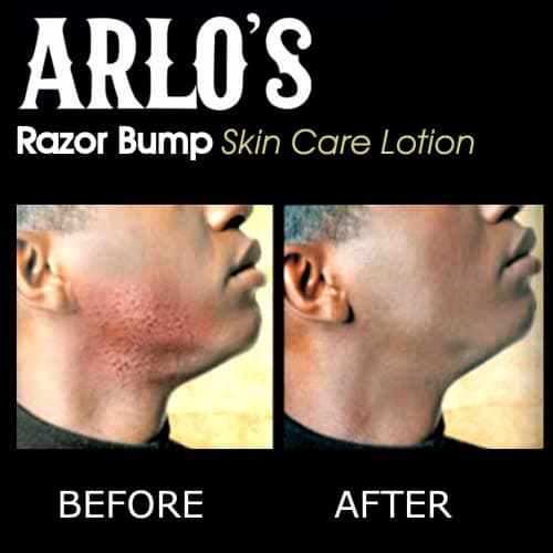 ARLO'S RAZOR BUMP SKIN CARE LOTION 177 3