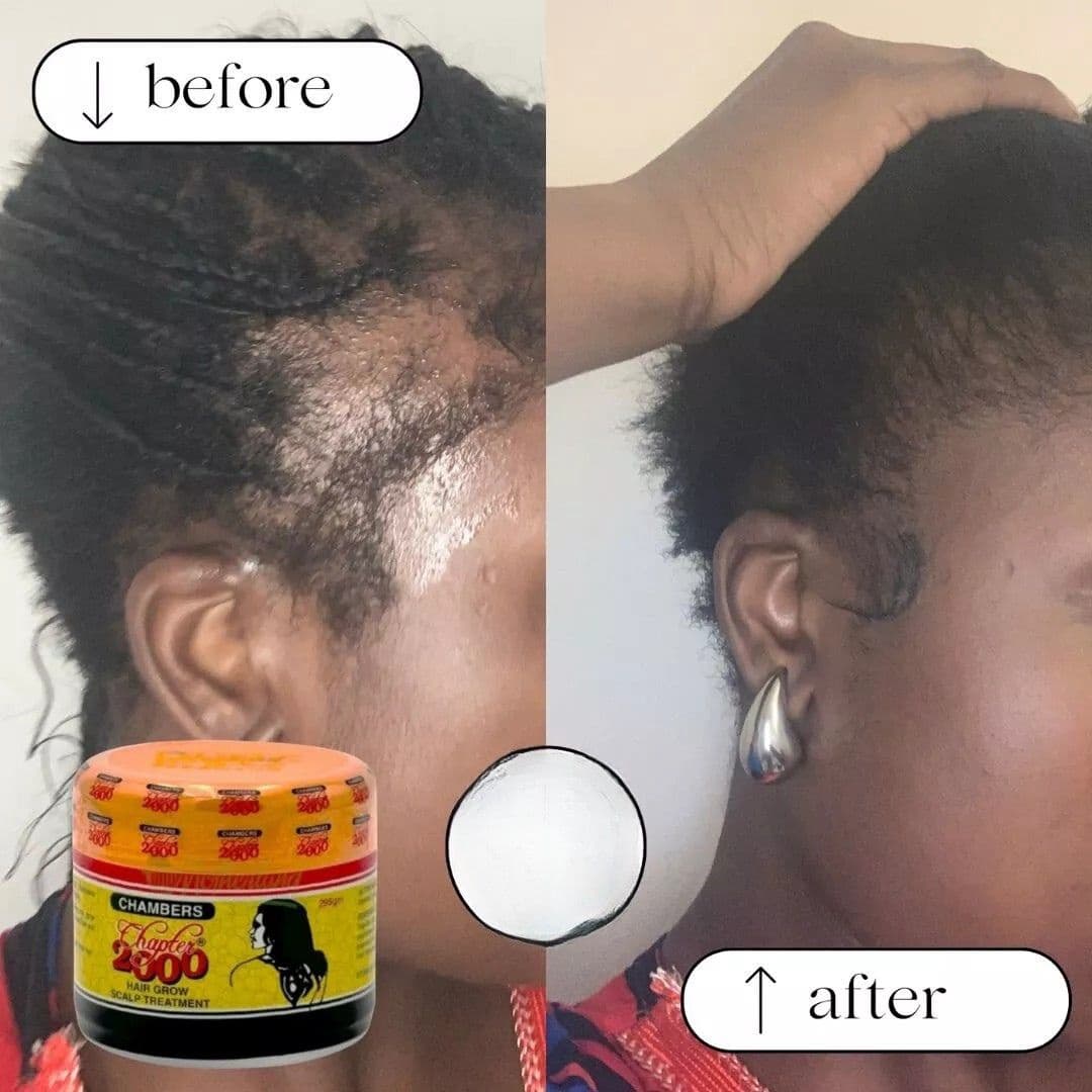 Chambers Chapter 2000 | Best Hair Loss Treatment  For Female & Men(175gm) 3